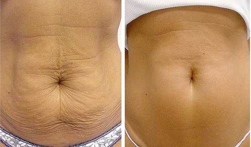 Radio Frequency Tummy Tightening - VIVO Clinic